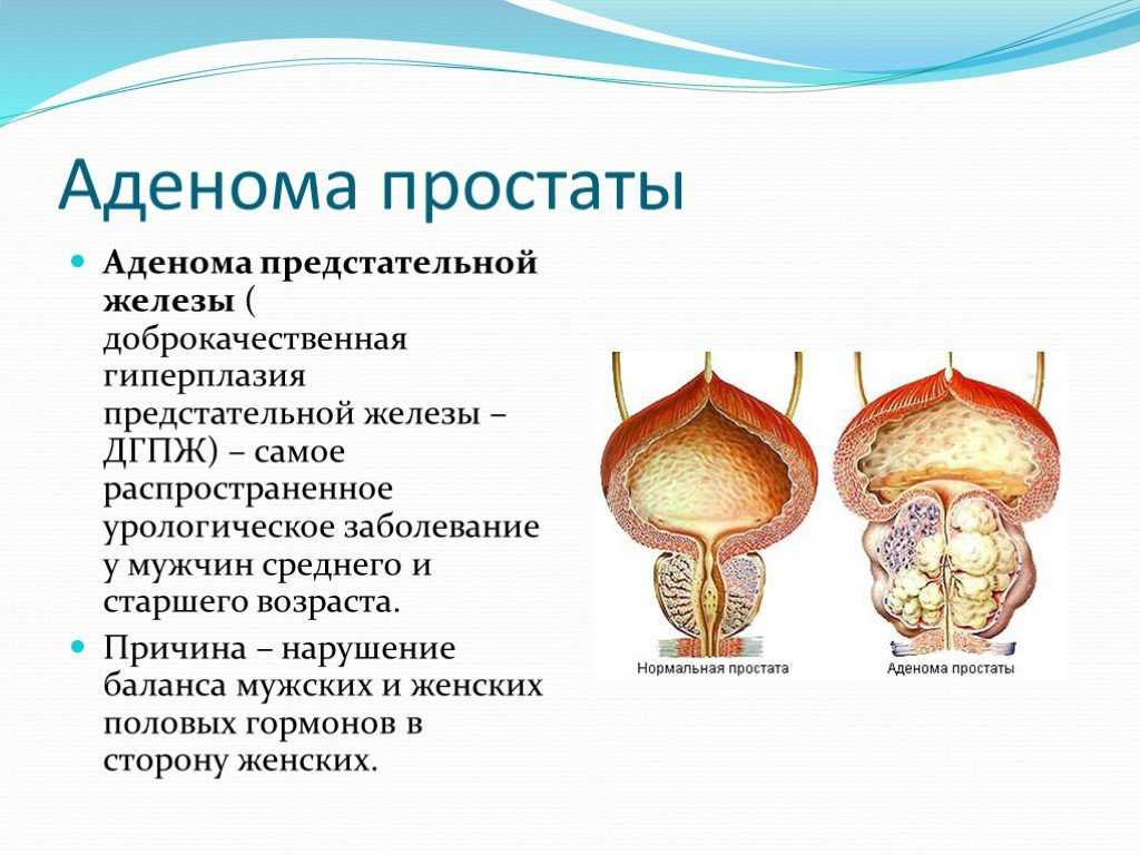 Простой предстательной железы