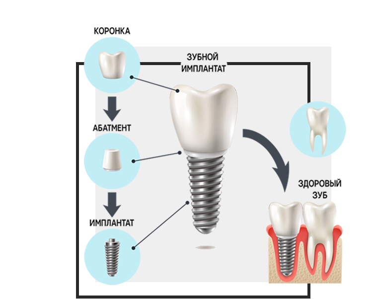 Коронку на зуб ставить корень. Имплантация абатмент коронка. Имплант Nobel винт для коронки. Циркониевая коронка на имплант Osstem. Схема имплант абатмент коронка.