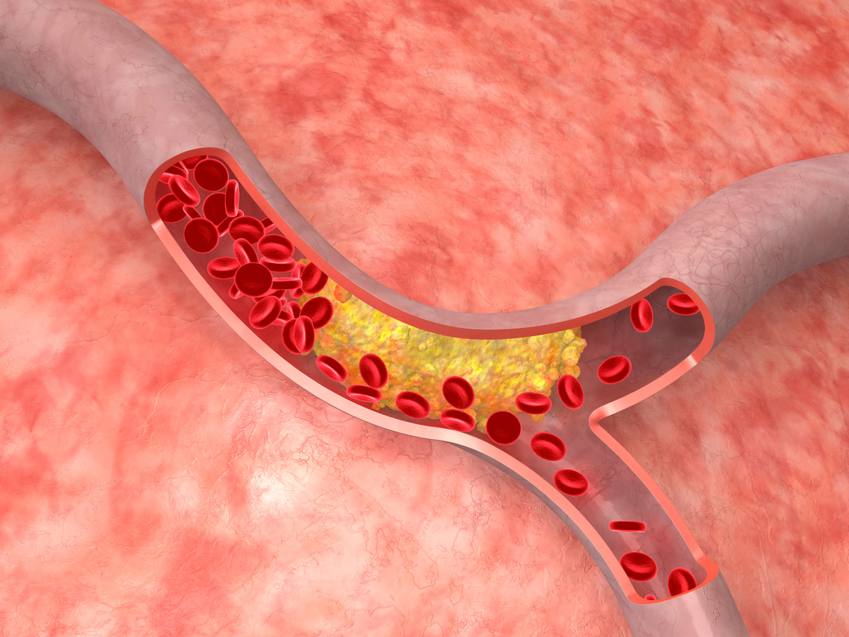 Жировая эмболия почечных капилляров. Воздушная эмболия сосудов. Тромбоз закупорка сосудов. Атеросклероз венечных артерий. Закупорка кровеносных сосудов.