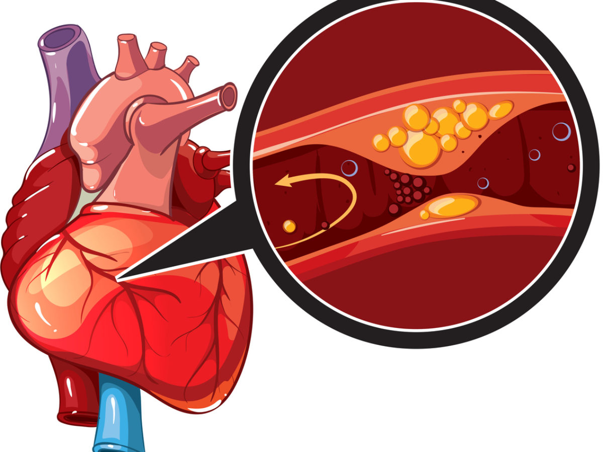 Тромбоз коронарных артерий. Инфаркт миокарда сосуды. Инфаркт миокарда тромб. Бляшки инфаркт миокарда. Инфаркт миокарда тромб атеросклероз.
