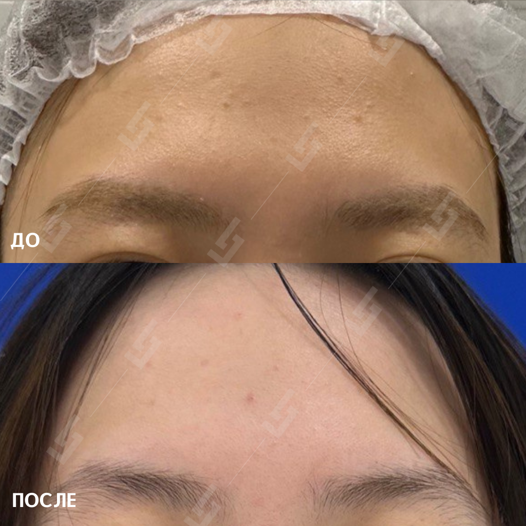 Ботокс для бровей как делать. Ламинирование и ботокс бровей. Ботокс для бровей как делать. Ботокс для бровей как делать. Ботокс бровей до и после.