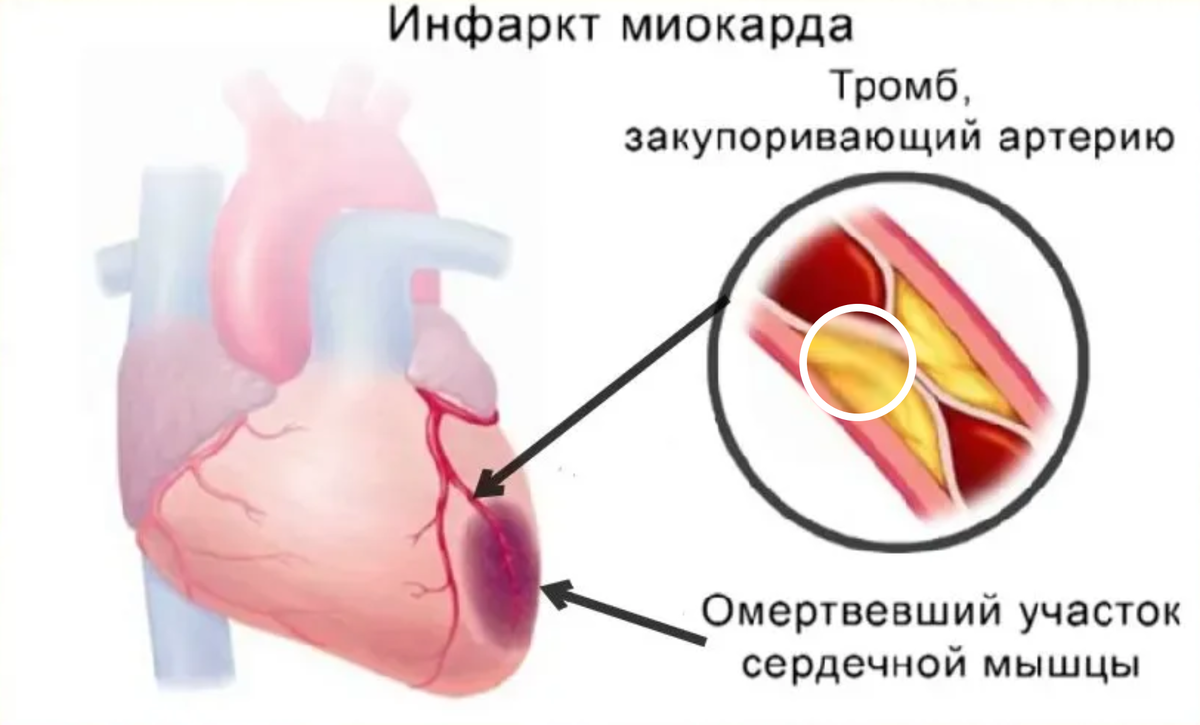 Стрессовый инфаркт. Кардиомаркеры инфаркта миокарда. Оксигенотерапия при инфаркте миокарда. Перенесенный инфаркт миокарда. Причины повреждения миокарда.
