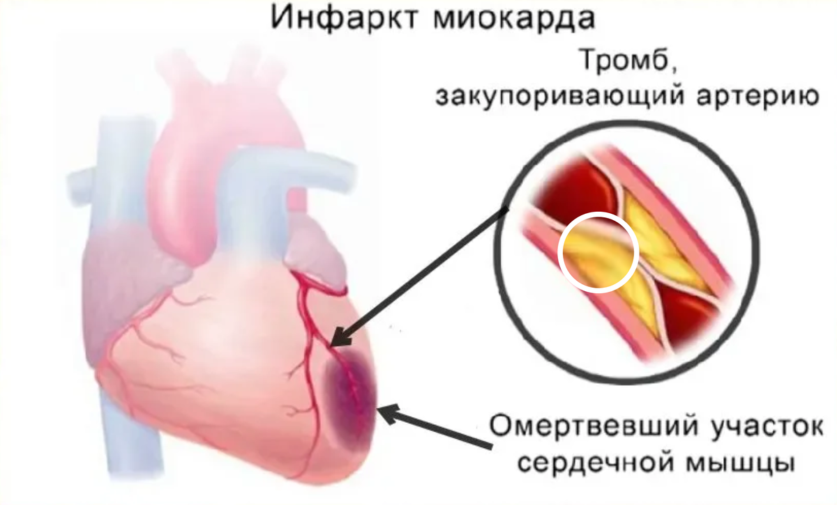 Кардиомаркеры инфаркта миокарда. Оксигенотерапия при инфаркте миокарда. Перенесенный инфаркт миокарда. Причины повреждения миокарда.