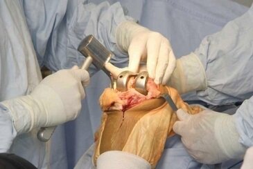 Процесс операции по эндопротезированию коленного сустава.