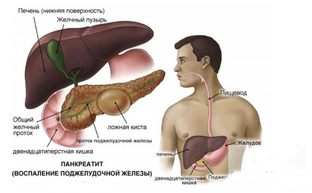 Протоки панкреатит