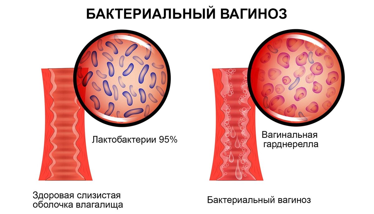 Влагалищный зуд и выделения - Гинекология и акушерство - Справочник MSD Профессиональная версия