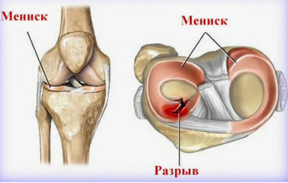 Лечение разрыва мениска коленного. Разрыв медиального мениска коленного сустава. Медиальный мениск разрыв медиального. Корень мениска анатомия. Мениски коленного сустава анатомия разрыв.