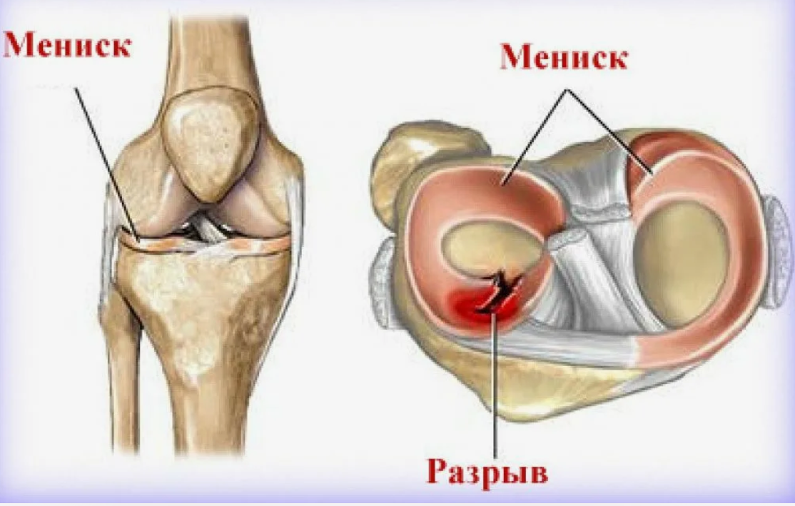 Разрыв мениска что это такое. Разрыв мениска коленного сустава. Разрыв мениска коленного симптомы. Повреждение медиального мениска коленного сустава. Травма мениска коленного сустава.