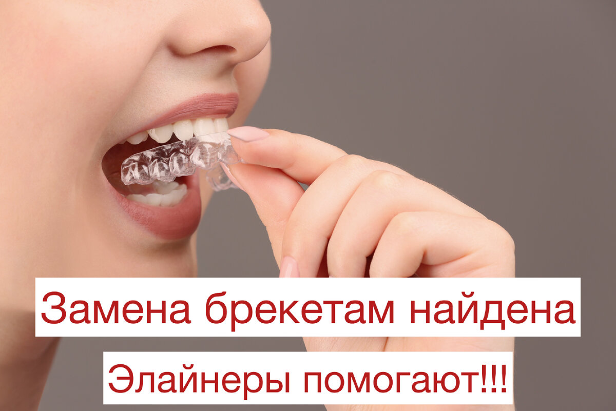 Элайнеры цена