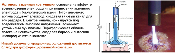 Плазма в гинекологии. Аргон-плазменная коагуляция. Эндоскопическая аргоноплазменная коагуляция. Аргоноплазменная деструкция шейки. Аргоноплазменная коагуляция шейки.