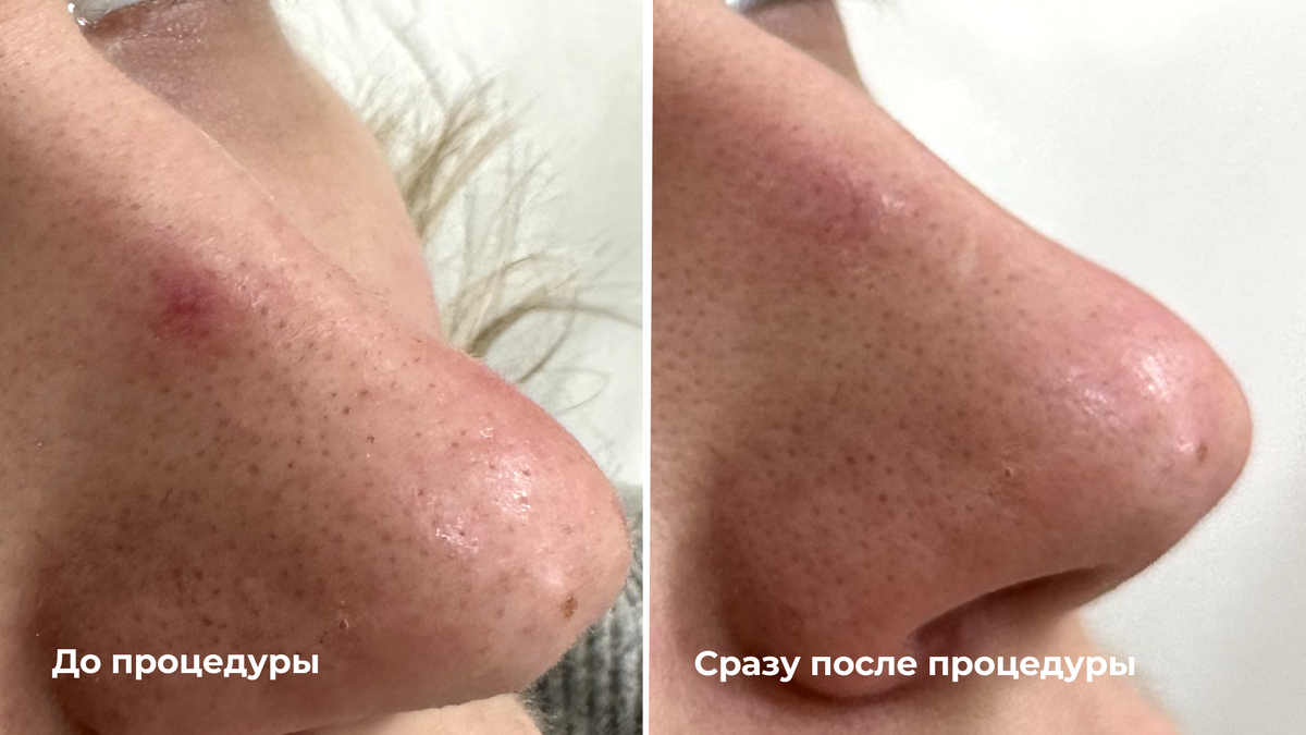 Лазерное удаление сосуда на носу