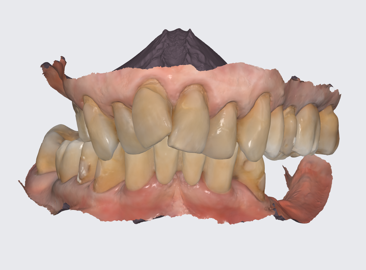 3Д слепок челюстей