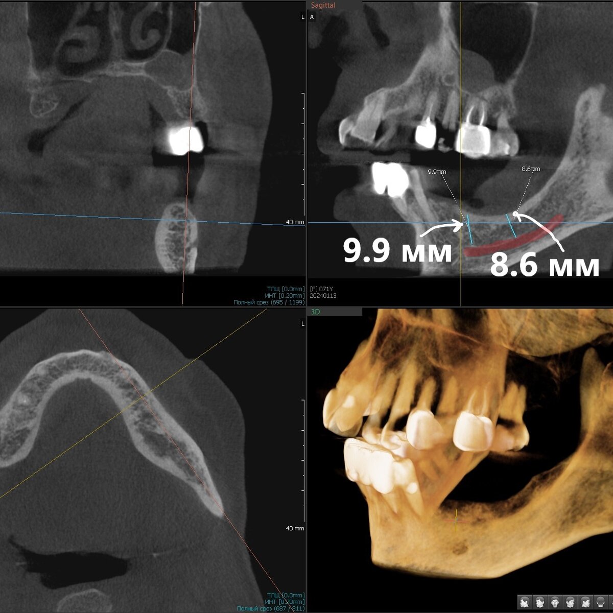 3Д КТ, область отсутствующих зубов на нижней челюсти