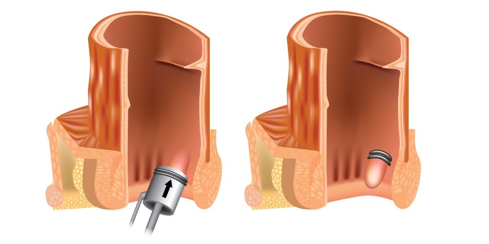 Наружный геморрой – методы лечения