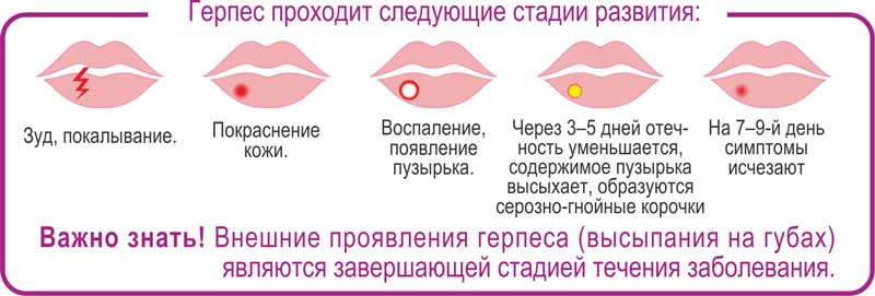Как быстро снять герпес