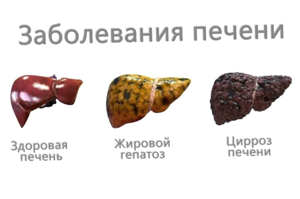 Жировая печень что это значит