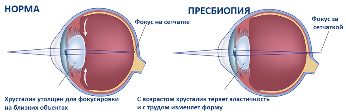 Когда восстанавливается зрение после замены хрусталика. Диагноз: гиперметропия слабой степени. Пресбиопия. Пресбиопия (возрастная дальнозоркость). Линзы для коррекции возрастной дальнозоркости. Пресбиопия это в офтальмологии.