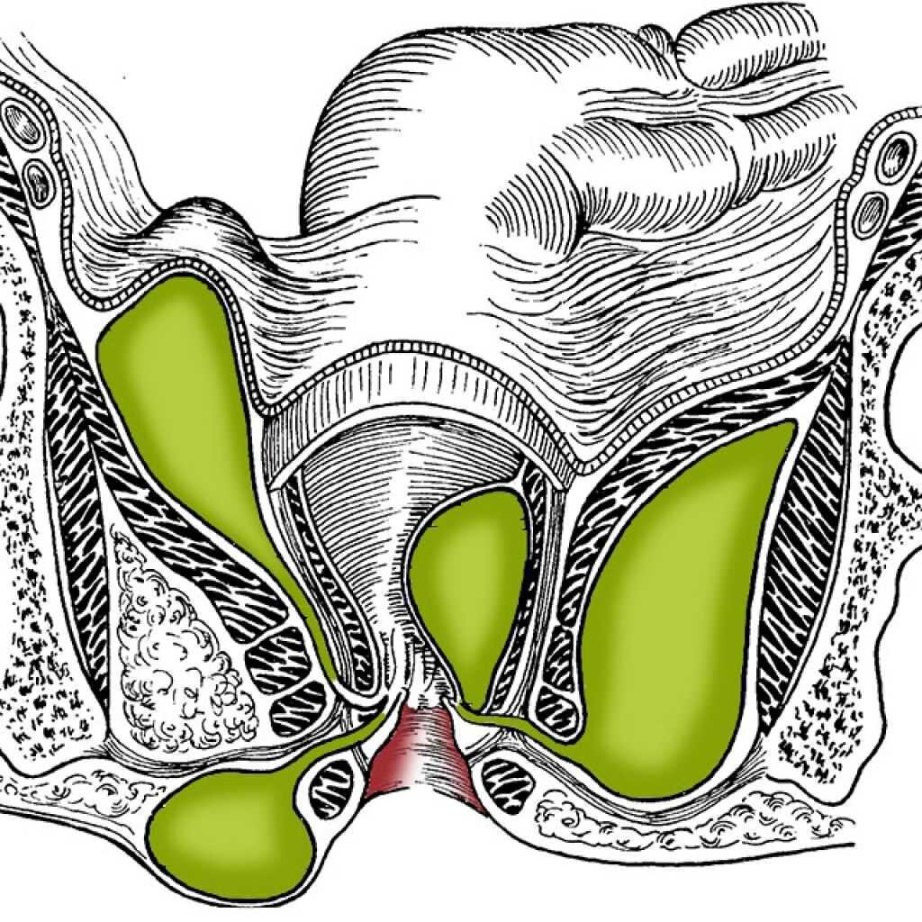 Парапроктит симптомы и причины. Острый Гнойный пельвиоректальный парапроктит. Парапроктит подкожный абсцесс. Острый подкожно-подслизистый парапроктит.