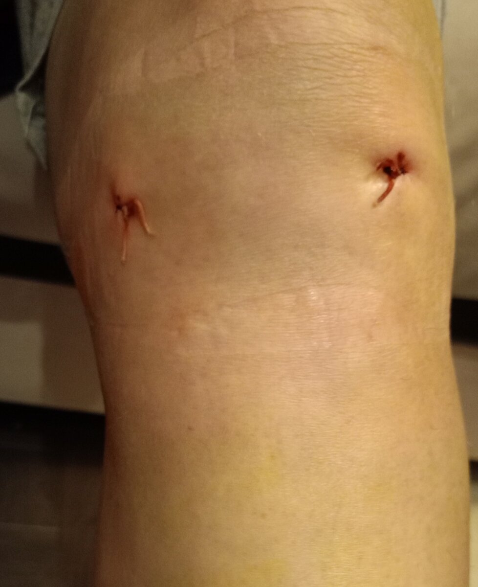 Швы дома через два дня после операции. Мне немного брррр.....