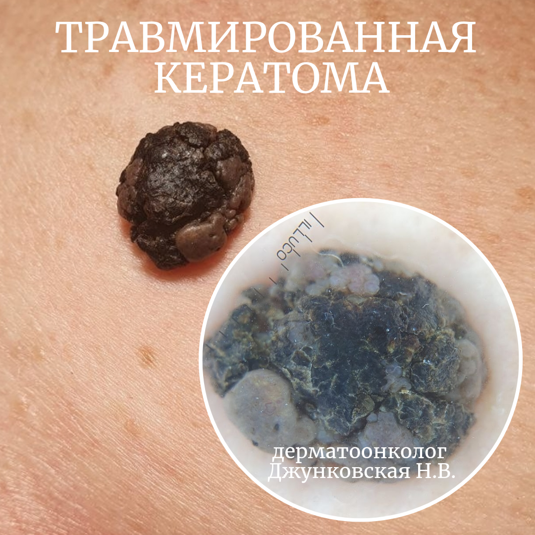 травмированная кератома, доброкачественное образование