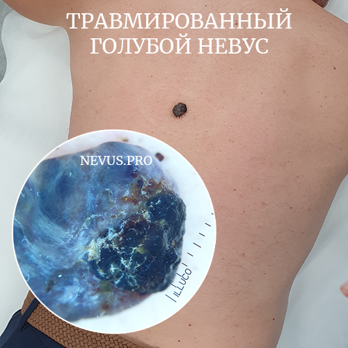 голубой невус, доброкачественное образование