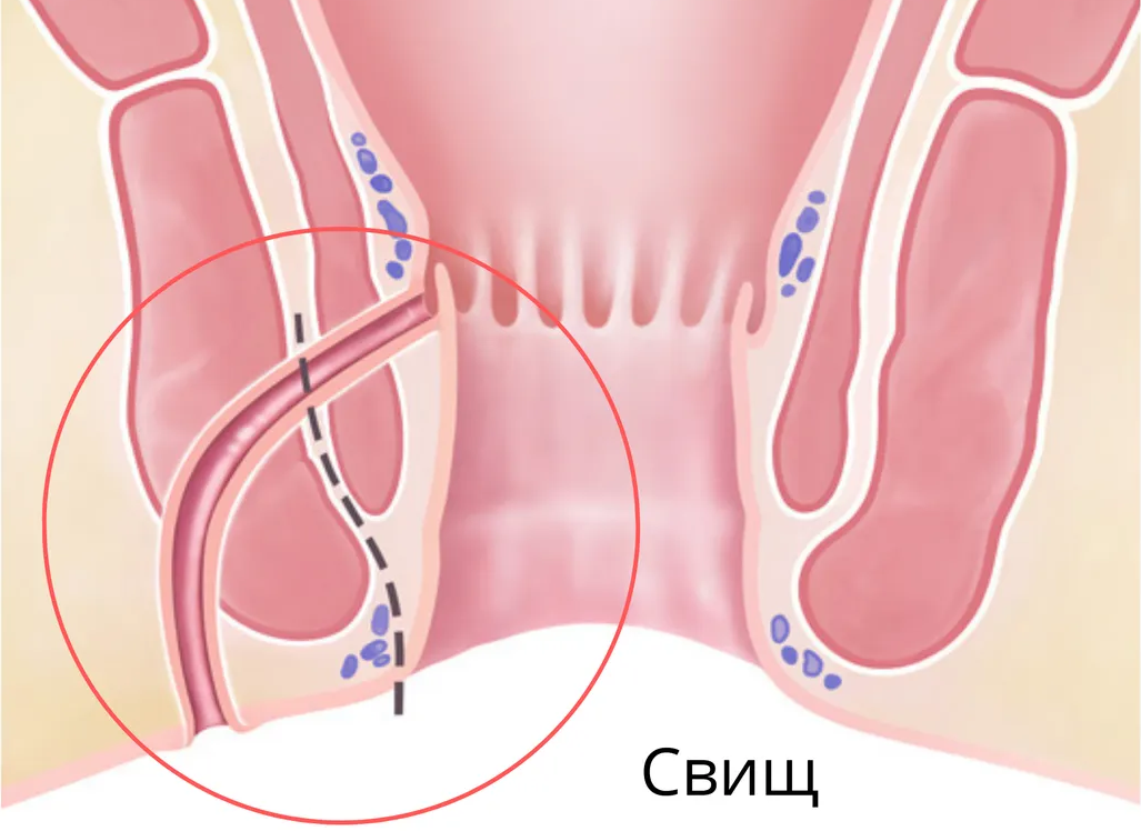 Парапроктит что это: симптомы, лечение и диагностика у взрослых и детей