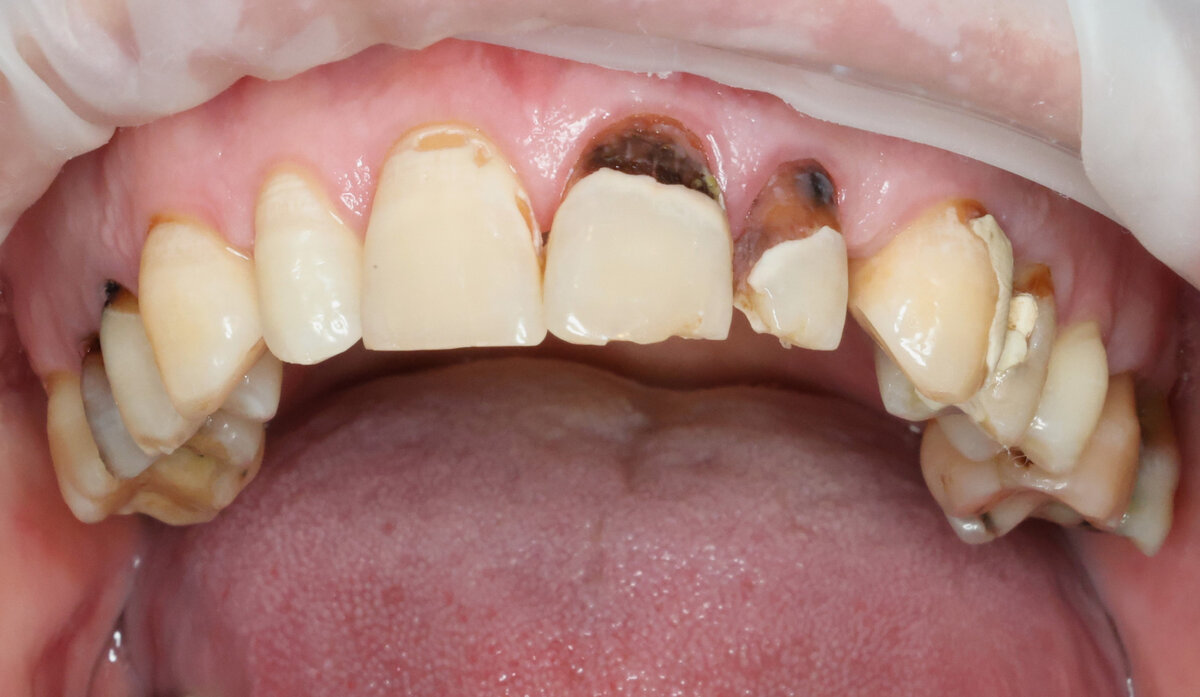 Кариес 2.1 и 2.2 зубов