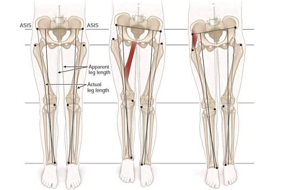 Функциональная длина. Разница в длине ног. Разная длина ног причины. Перекос таза и разная длина ног.