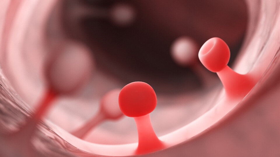 Полипы желудка как лечить?