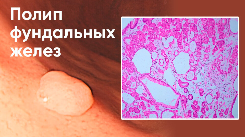 Полип фундальных желез желудка
