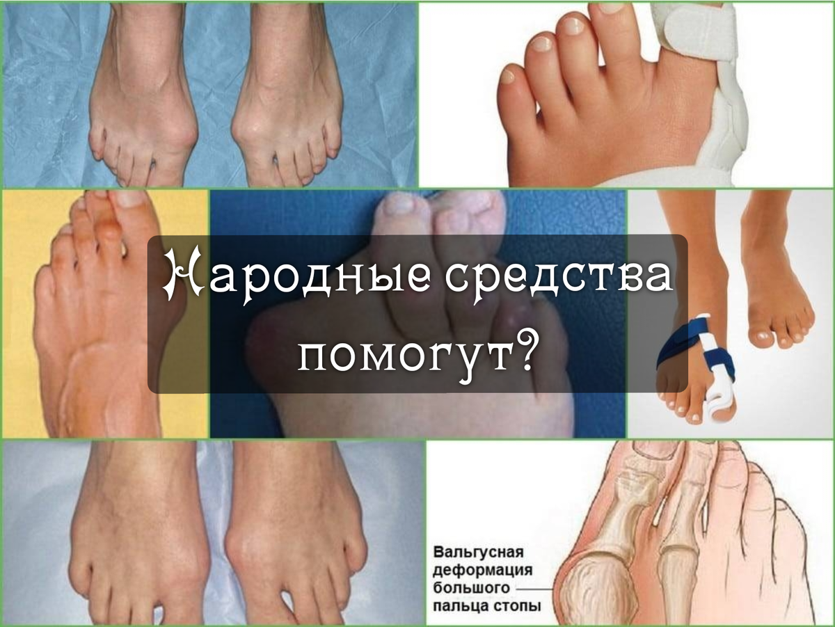 Вальгусная деформация или «косточка» большого пальца ноги