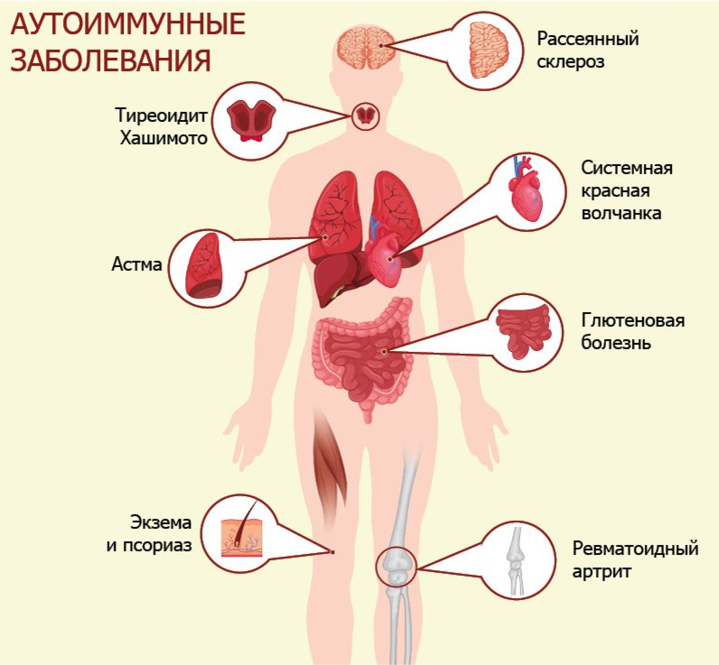 Болезнь Крона, аутоиммунный тиреоидит Хашимото, системная красная волчанка, псориаз, болезнь Бехтерева, ревматоидный артрит, диабет 1-го типа — это лишь малая часть аутоиммунных заболеваний.-2