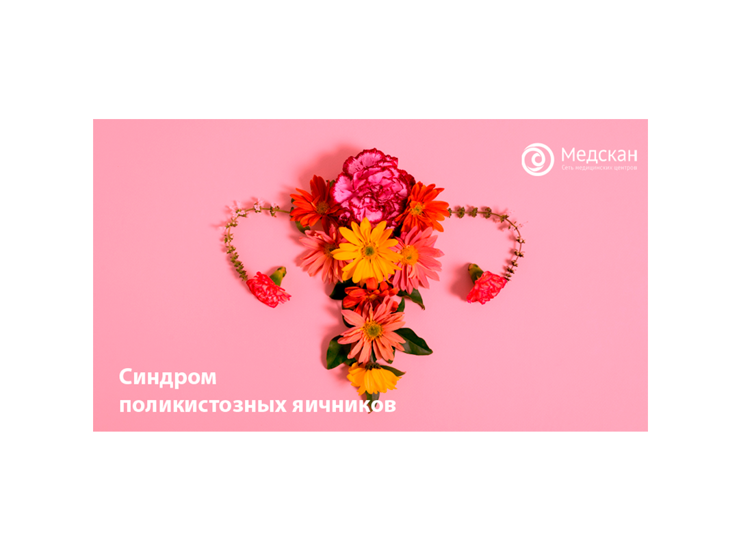 Синдром поликистозных яичников