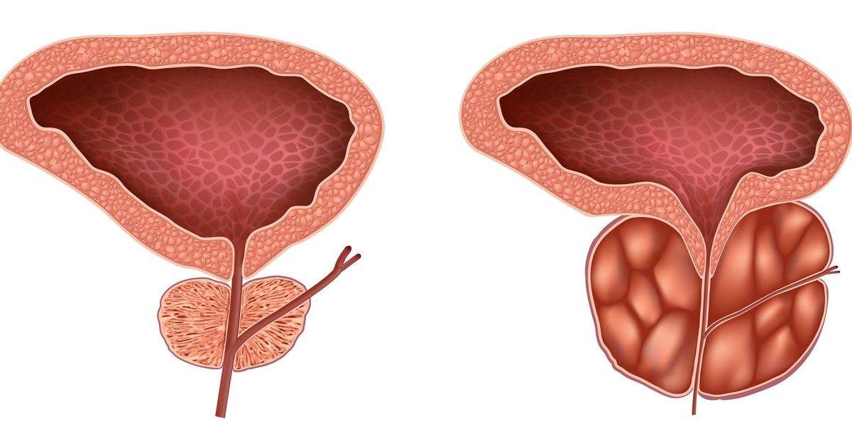 Аденома простаты у мужчин: лечение простатита и аденомы предстательной железы
