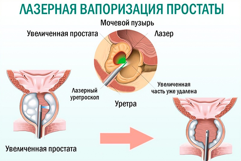 Лазерная вапоризация предстательной железы. Лазерная вапоризация аденомы предстательной железы. Лазерная энуклеация аденомы предстательной железы. Трансуретральная энуклеация простаты лазером. Гиперплазия предстательной железы операция