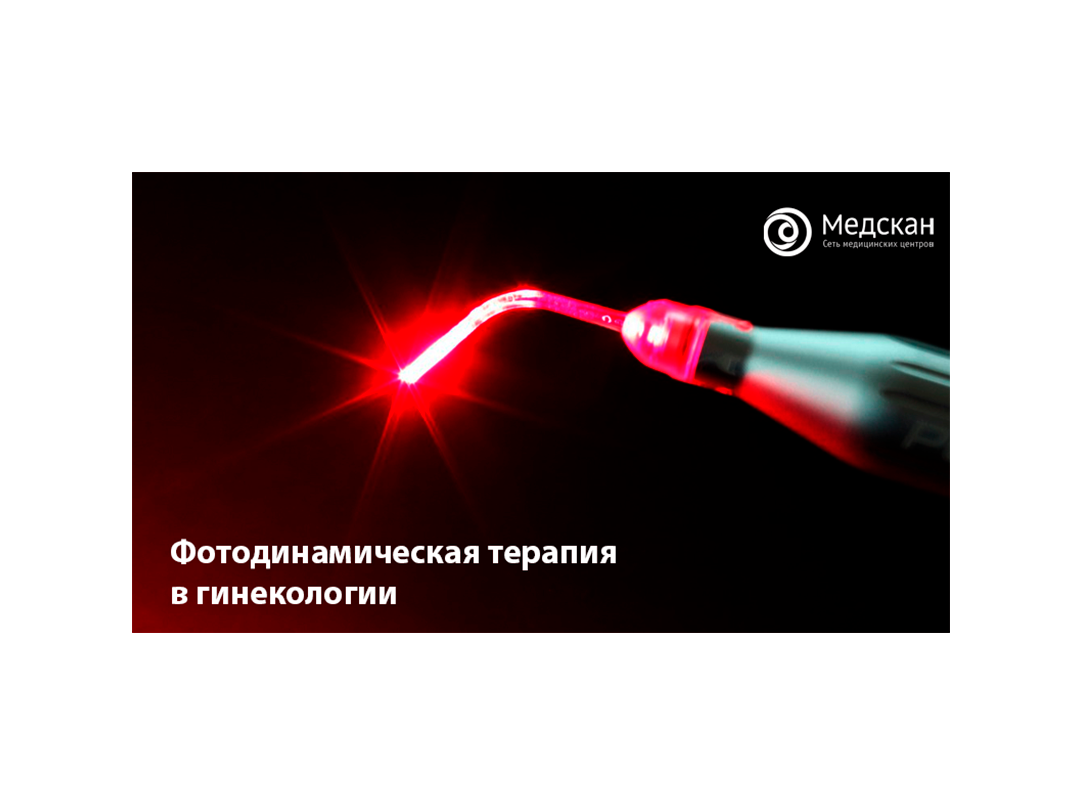 Фотодинамическая терапия в гинекологии