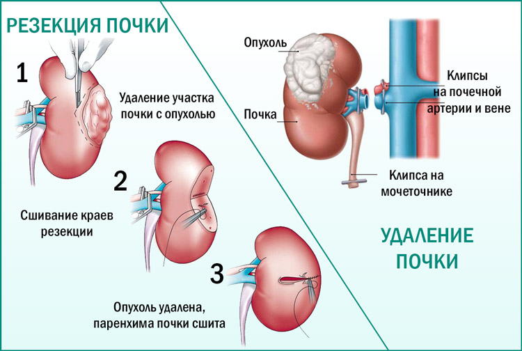 Есть ли рак почки