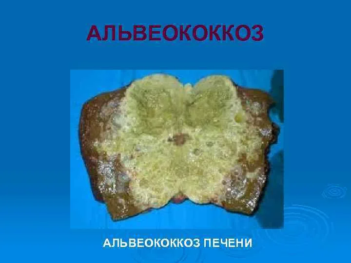 Альвеококкоз печени и его лечение, макропрепараты и …