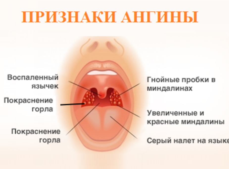 Ангина при беременности. Что такое Ангина при беременности?