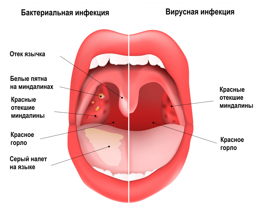 Чем лечить горло при беременности: безопасные методы