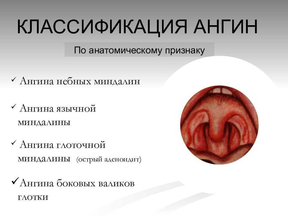 Ангина при беременности: симптомы и последствия — Гинекология