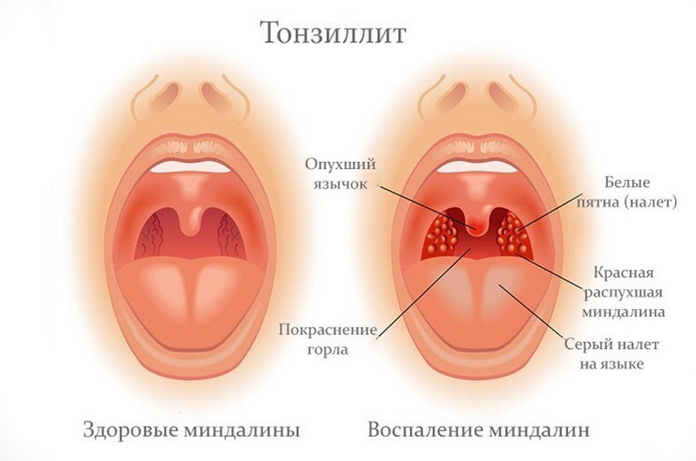 Хронический тонзиллит, обострение - лечение при беременности