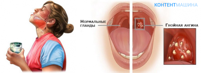 Бактериальная ангина в 1 триместре беременности — вопрос №456410