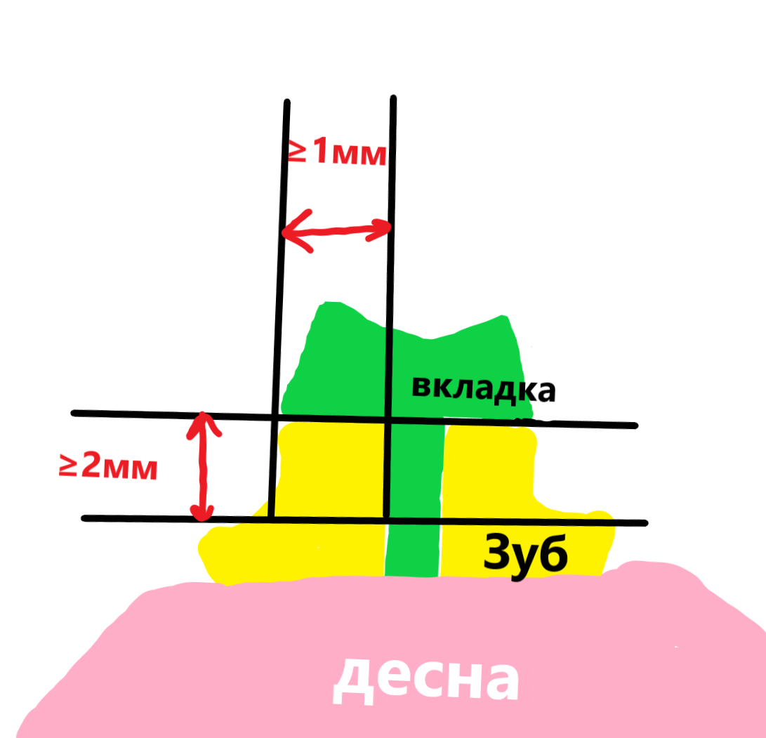 Культевые вкладки - важные особенности и стоимость. Что выбрать - обычные  металлические или красивые циркониевые | Parodoctor | Дзен