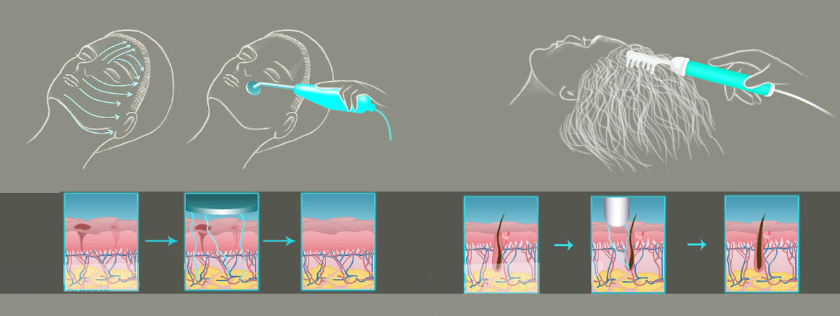 Дарсонваль - это прибор, который оказывает на организм физиотерапевтическое воздействие током малой силы, но высокой частоты. Используется не только для волос, но и для кожи лица и тела (есть несколько видов насадок)