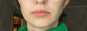 Отек слева. 1 день.