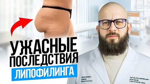 СВИСАЮЩИЕ ЯГОДИЦЫ. Последствия липофилинга