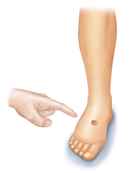 Чтобы проверить наличие отека, врачи могут нажать на кожу, а затем убрать палец. Если вмятина остается, значит, у человека отек. Врачи называют это «точечным отеком».