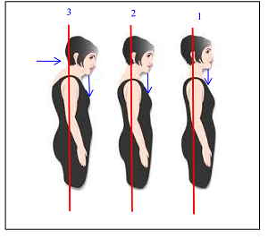 1 - нормальное положение головы и шеи (вертикальная ось проходит через ухо и плечевой сустав, подбородок над ключицами), 2 - начальная стадия отклонений от оси (подбородок над грудиной), 3 - сильная деформация шеи (подбородок над грудью, ось проходит через затылок)