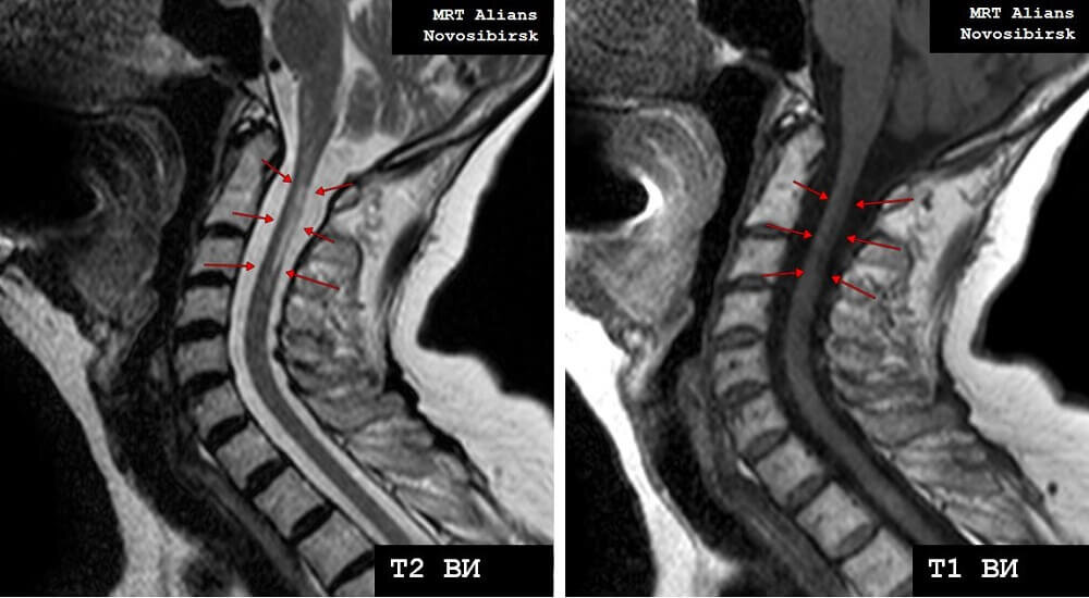 Мрт шейного отдела новосибирск. Гидросирингомиелия мрт. Рассеянный склероз шейного отдела мрт. Снимок мрт шейного отдела.